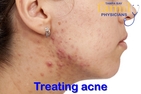 Tampa Bay Family Physicians Treat Acne