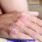 Tampa Bay Family Physicians Treat Psoriasis