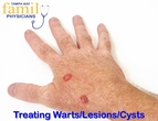 Tampa Bay Family Physicians Treat Warts Lesions Cysts
